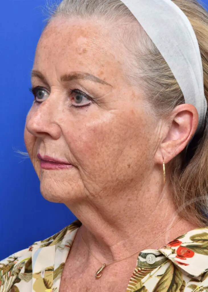 Plastic Surgery Before and After Pictures in Jacksonville, FL - Garcia Facial Plastic Surgery