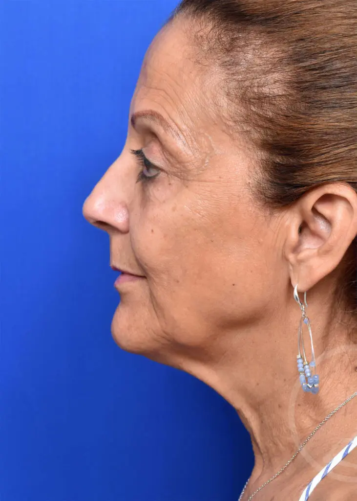 Plastic Surgery Before and After Pictures in Jacksonville, FL - Garcia Facial Plastic Surgery