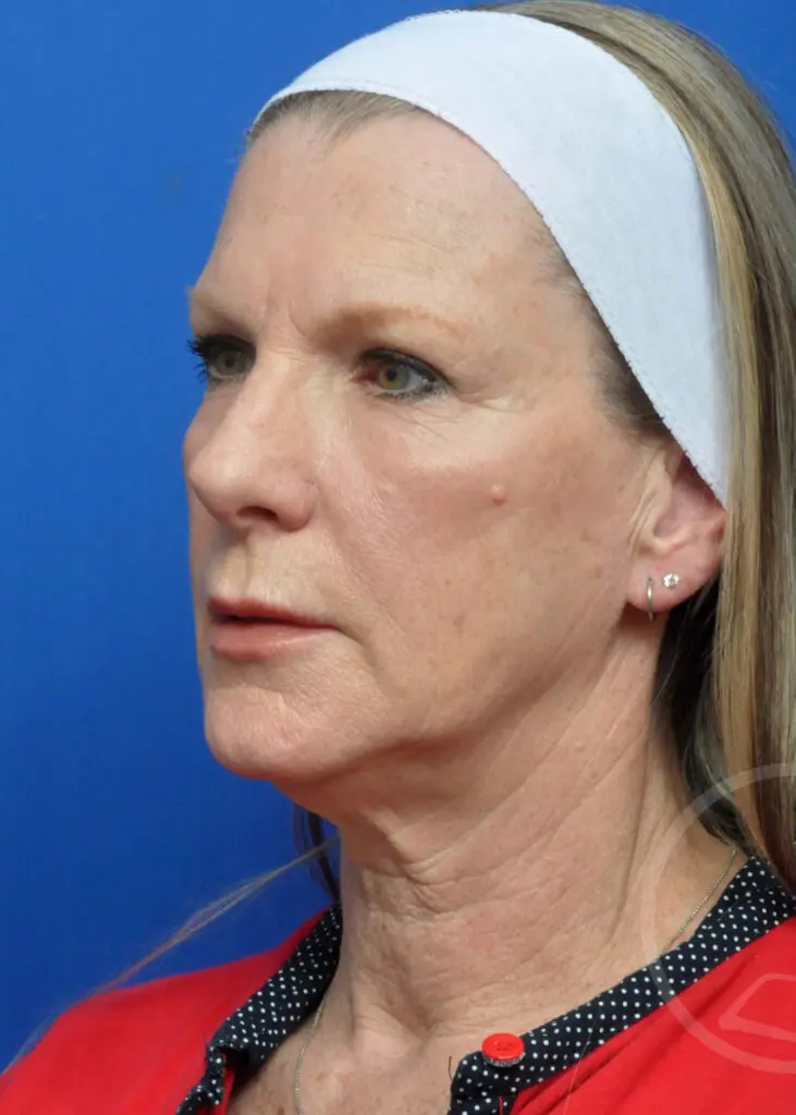 Plastic Surgery Before and After Pictures in Jacksonville, FL - Garcia Facial Plastic Surgery