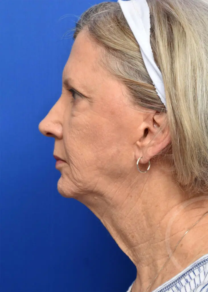Plastic Surgery Before and After Pictures in Jacksonville, FL - Garcia Facial Plastic Surgery