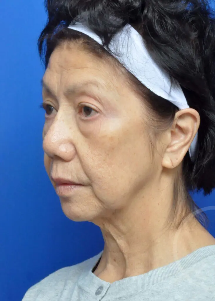 Plastic Surgery Before and After Pictures in Jacksonville, FL - Garcia Facial Plastic Surgery