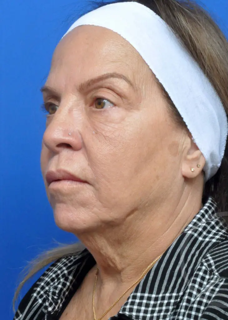 Plastic Surgery Before and After Pictures in Jacksonville, FL - Garcia Facial Plastic Surgery
