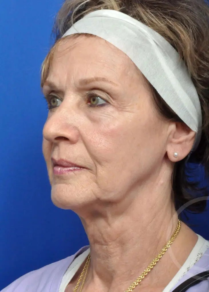 Plastic Surgery Before and After Pictures in Jacksonville, FL - Garcia Facial Plastic Surgery