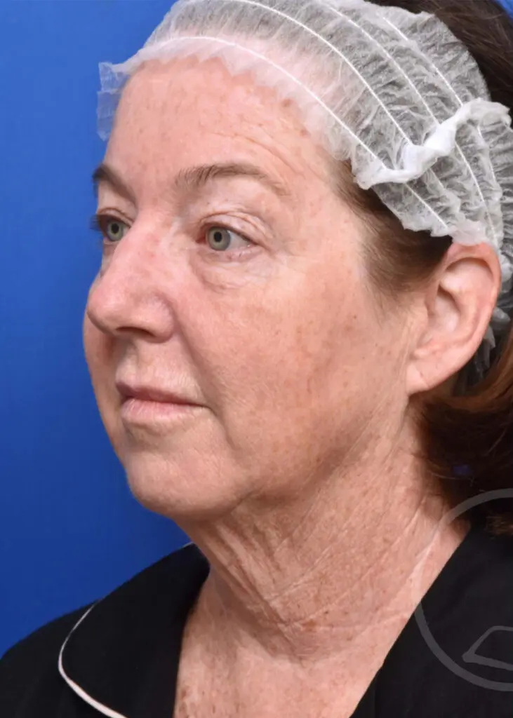 Plastic Surgery Before and After Pictures in Jacksonville, FL - Garcia Facial Plastic Surgery