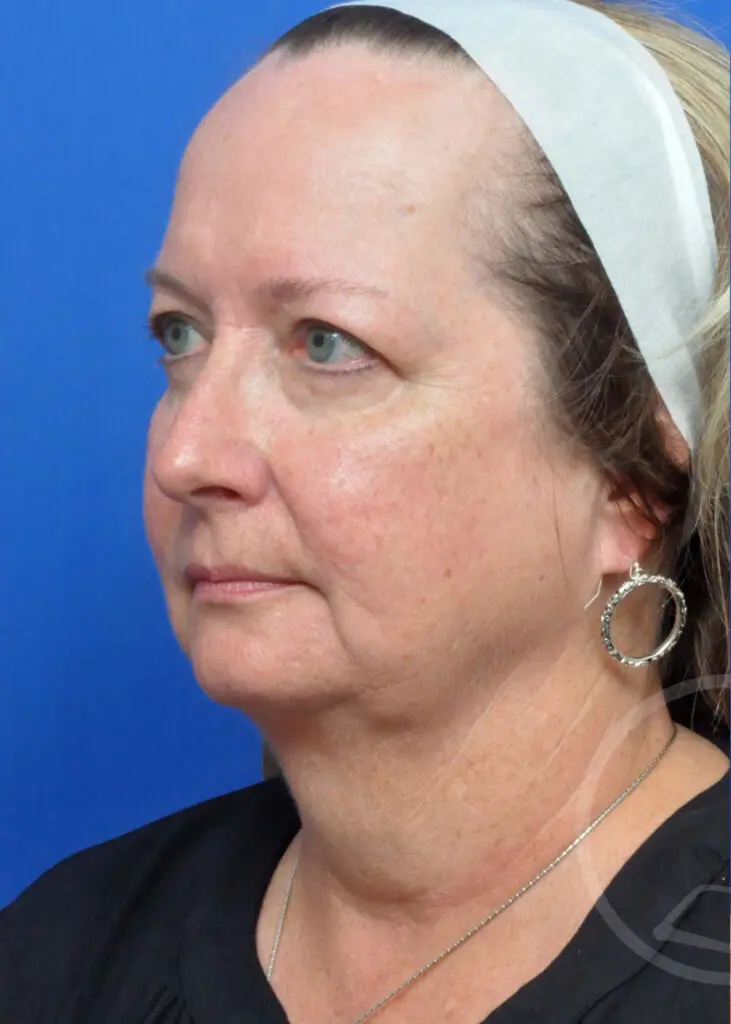 Plastic Surgery Before and After Pictures in Jacksonville, FL - Garcia Facial Plastic Surgery