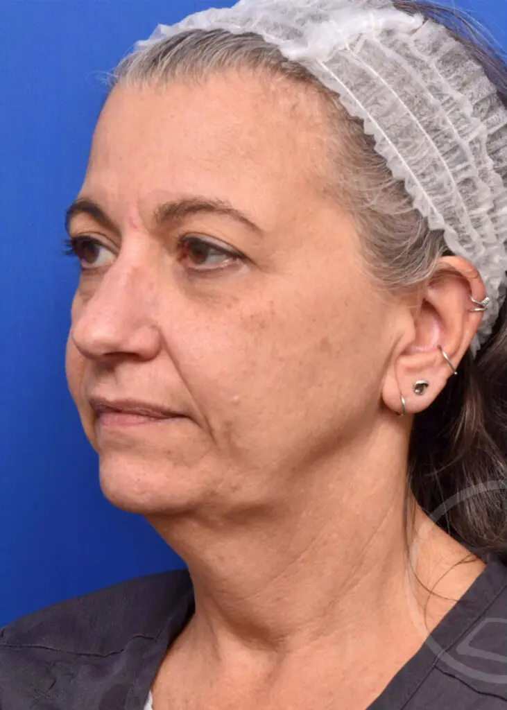 Plastic Surgery Before and After Pictures in Jacksonville, FL - Garcia Facial Plastic Surgery