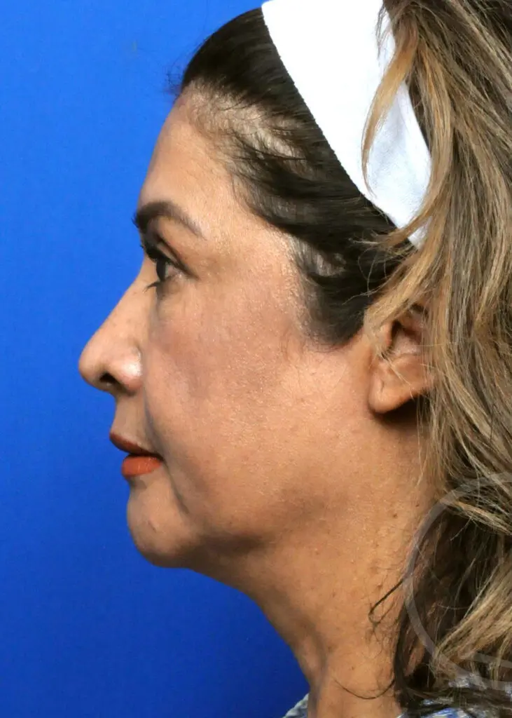 Plastic Surgery Before and After Pictures in Jacksonville, FL - Garcia Facial Plastic Surgery