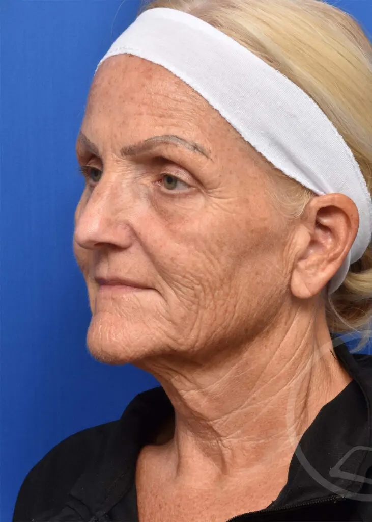 Plastic Surgery Before and After Pictures in Jacksonville, FL - Garcia Facial Plastic Surgery