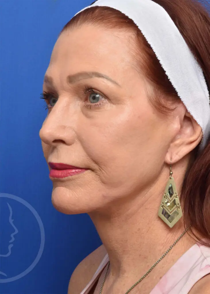 Plastic Surgery Before and After Pictures in Jacksonville, FL - Garcia Facial Plastic Surgery