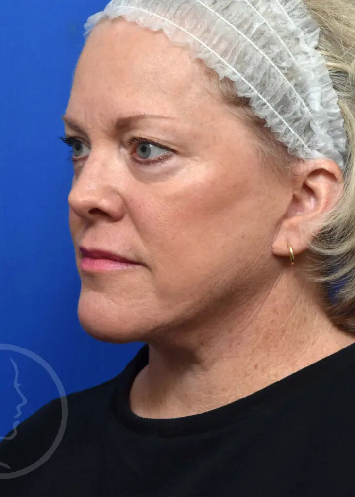 Plastic Surgery Before and After Pictures in Jacksonville, FL - Garcia Facial Plastic Surgery