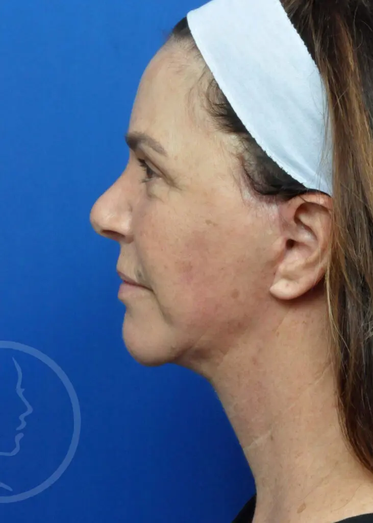 Plastic Surgery Before and After Pictures in Jacksonville, FL - Garcia Facial Plastic Surgery