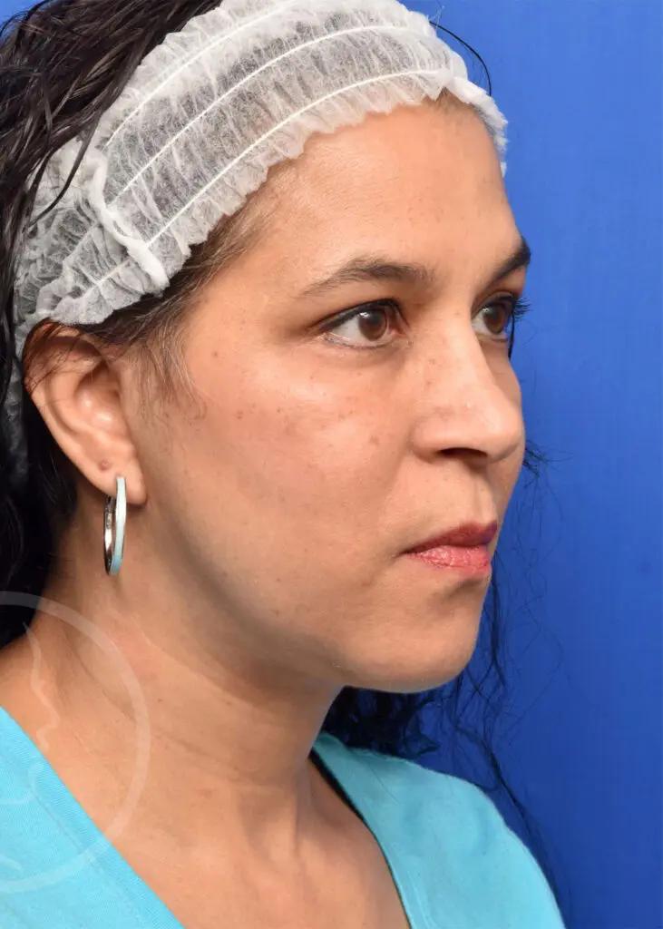 Plastic Surgery Before and After Pictures in Jacksonville, FL - Garcia Facial Plastic Surgery