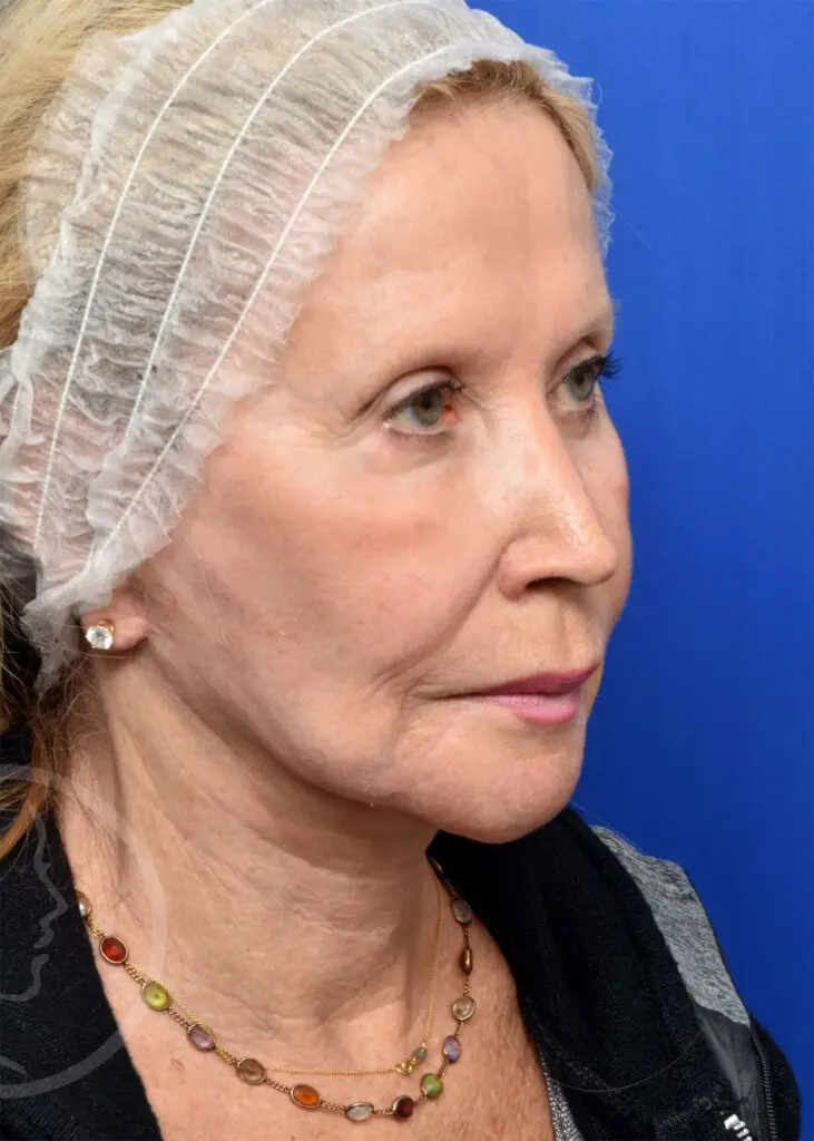 Plastic Surgery Before and After Pictures in Jacksonville, FL - Garcia Facial Plastic Surgery