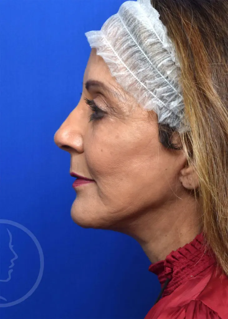 Plastic Surgery Before and After Pictures in Jacksonville, FL - Garcia Facial Plastic Surgery