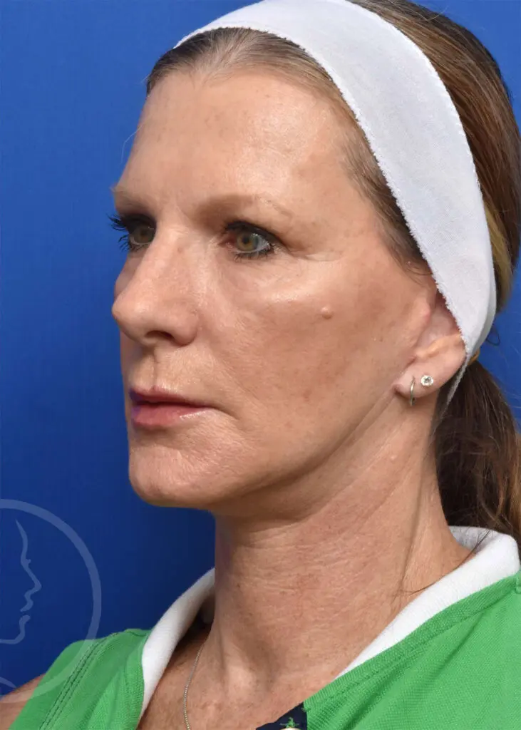 Plastic Surgery Before and After Pictures in Jacksonville, FL - Garcia Facial Plastic Surgery