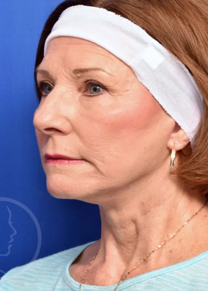 Plastic Surgery Before and After Pictures in Jacksonville, FL - Garcia Facial Plastic Surgery