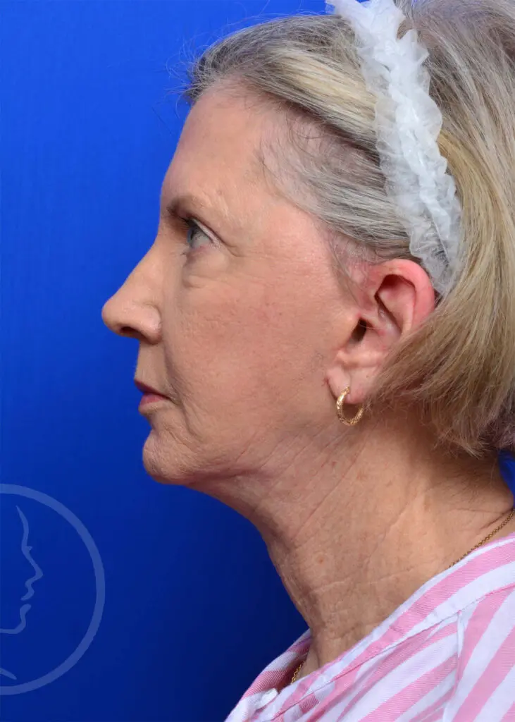 Plastic Surgery Before and After Pictures in Jacksonville, FL - Garcia Facial Plastic Surgery
