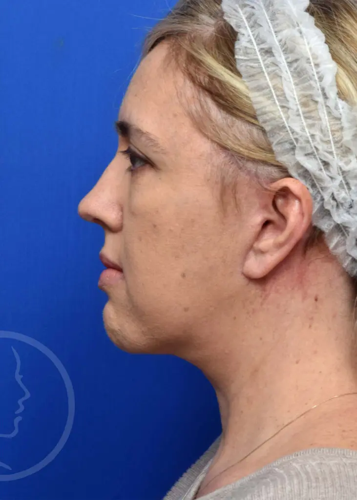 Plastic Surgery Before and After Pictures in Jacksonville, FL - Garcia Facial Plastic Surgery