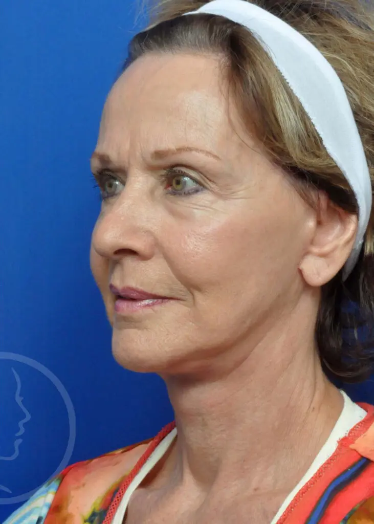 Plastic Surgery Before and After Pictures in Jacksonville, FL - Garcia Facial Plastic Surgery