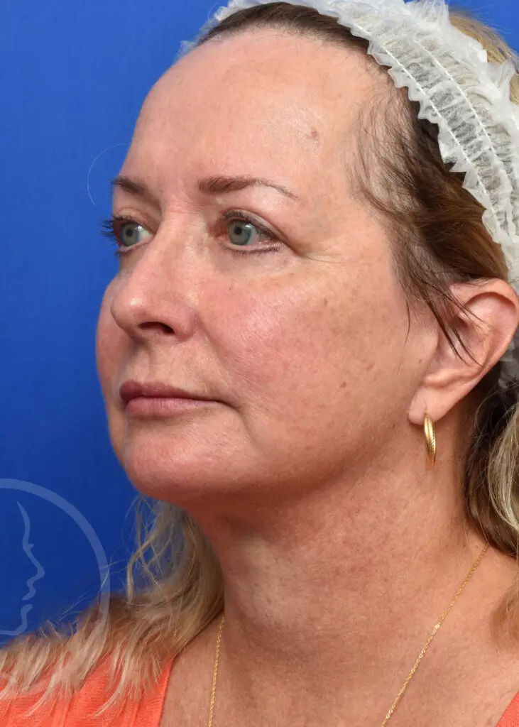 Plastic Surgery Before and After Pictures in Jacksonville, FL - Garcia Facial Plastic Surgery