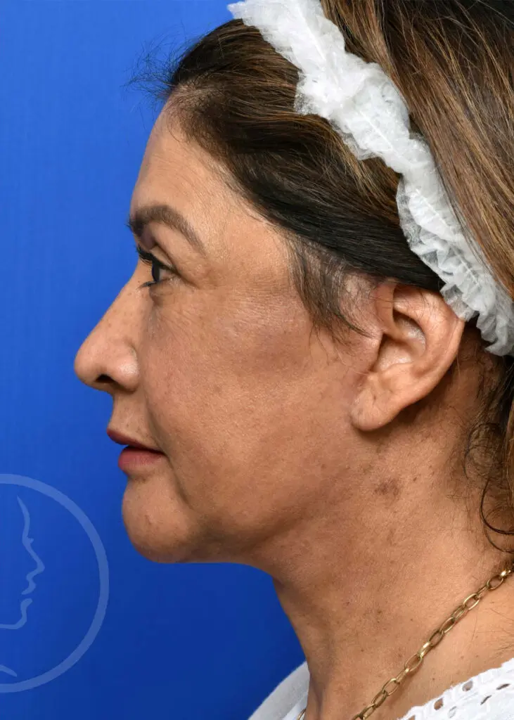 Plastic Surgery Before and After Pictures in Jacksonville, FL - Garcia Facial Plastic Surgery