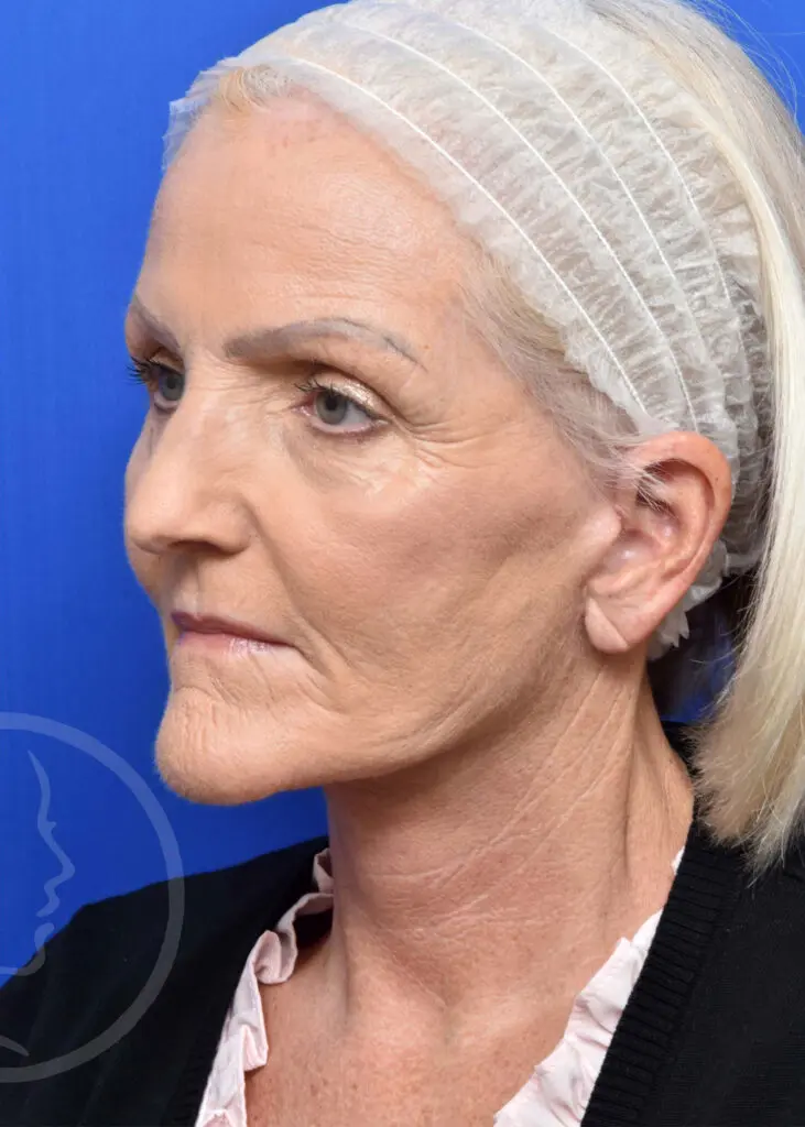 Plastic Surgery Before and After Pictures in Jacksonville, FL - Garcia Facial Plastic Surgery