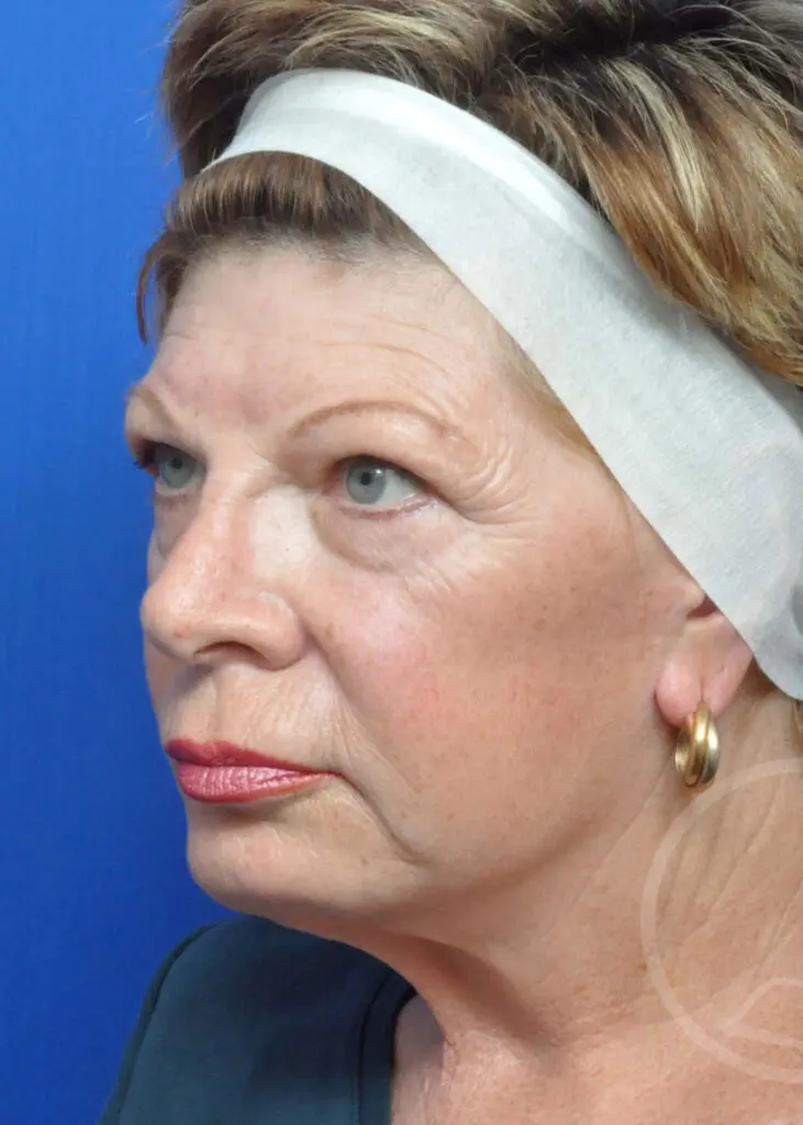 Plastic Surgery Before and After Pictures in Jacksonville, FL - Garcia Facial Plastic Surgery