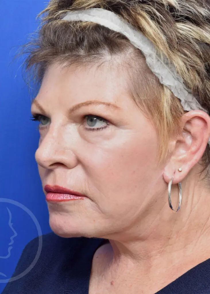 Plastic Surgery Before and After Pictures in Jacksonville, FL - Garcia Facial Plastic Surgery