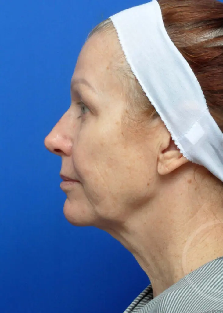 Plastic Surgery Before and After Pictures in Jacksonville, FL - Garcia Facial Plastic Surgery