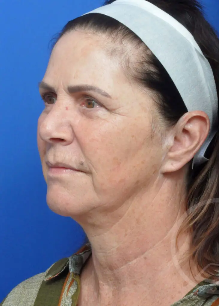 Plastic Surgery Before and After Pictures in Jacksonville, FL - Garcia Facial Plastic Surgery
