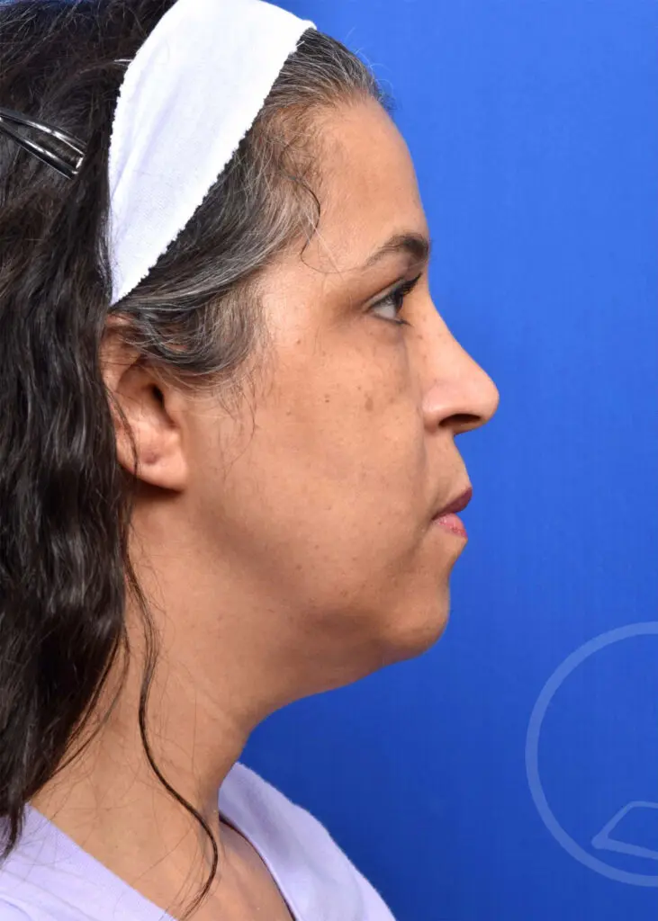 Plastic Surgery Before and After Pictures in Jacksonville, FL - Garcia Facial Plastic Surgery