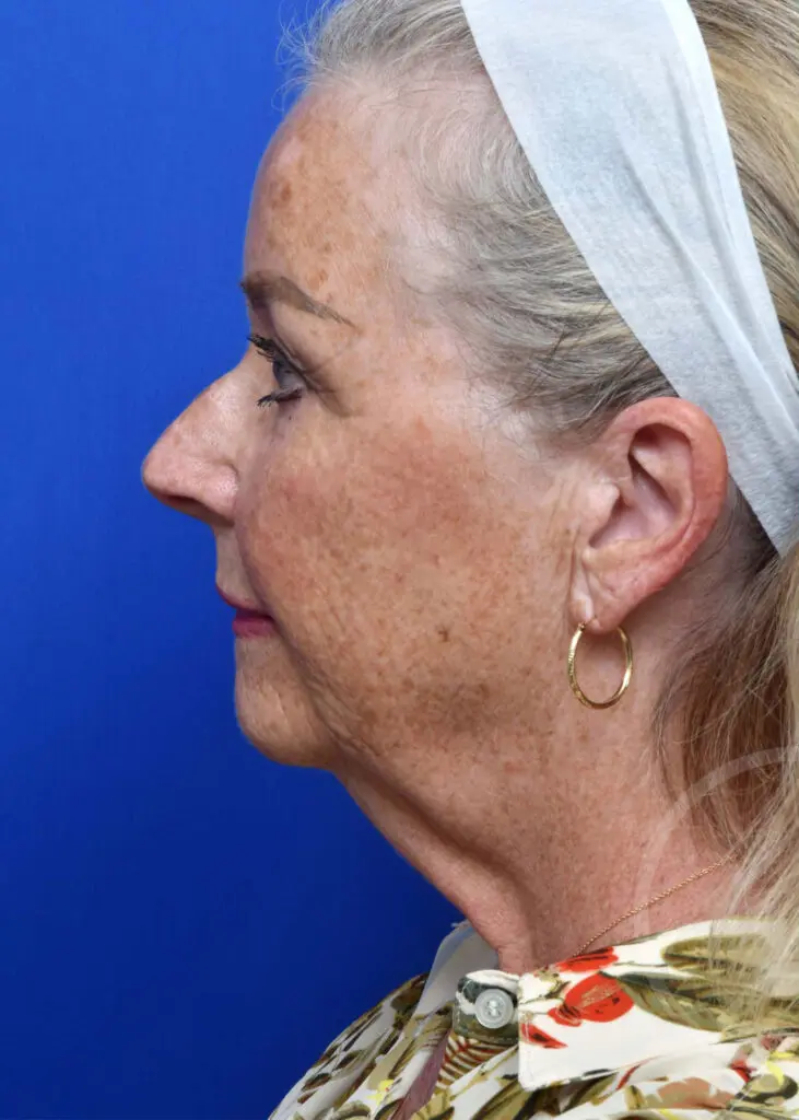 Plastic Surgery Before and After Pictures in Jacksonville, FL - Garcia Facial Plastic Surgery