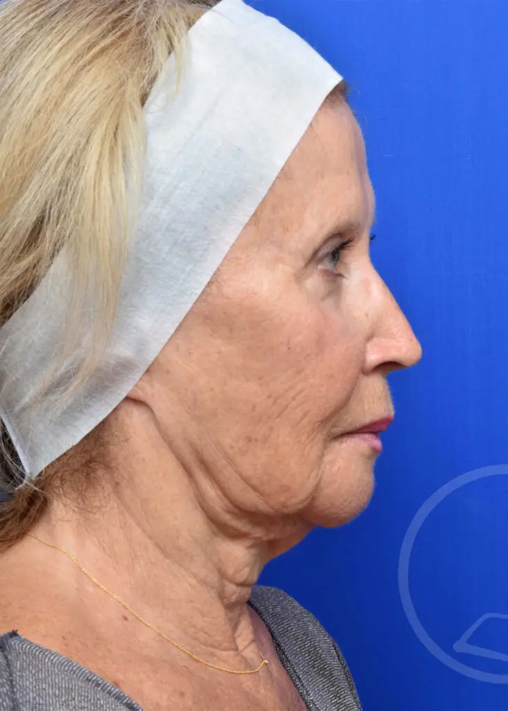 Plastic Surgery Before and After Pictures in Jacksonville, FL - Garcia Facial Plastic Surgery