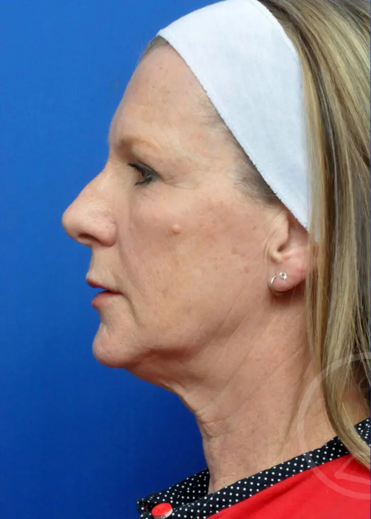 Plastic Surgery Before and After Pictures in Jacksonville, FL - Garcia Facial Plastic Surgery