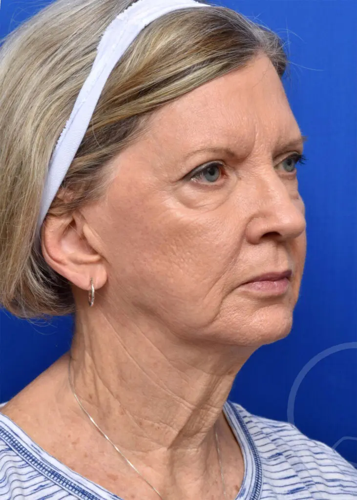Plastic Surgery Before and After Pictures in Jacksonville, FL - Garcia Facial Plastic Surgery