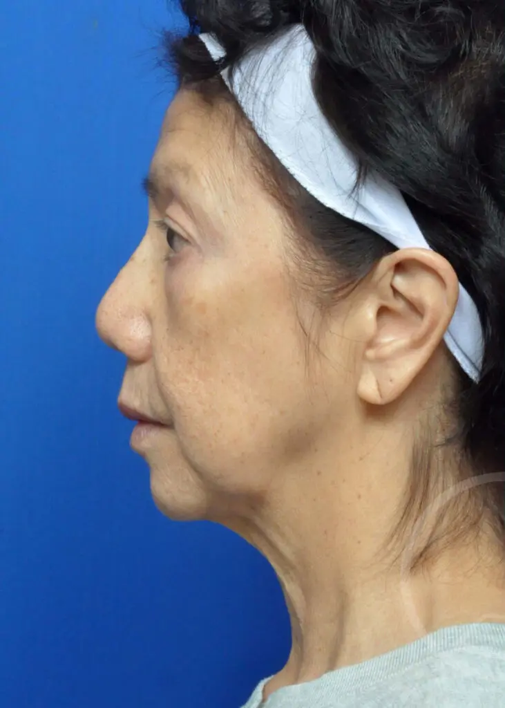 Plastic Surgery Before and After Pictures in Jacksonville, FL - Garcia Facial Plastic Surgery