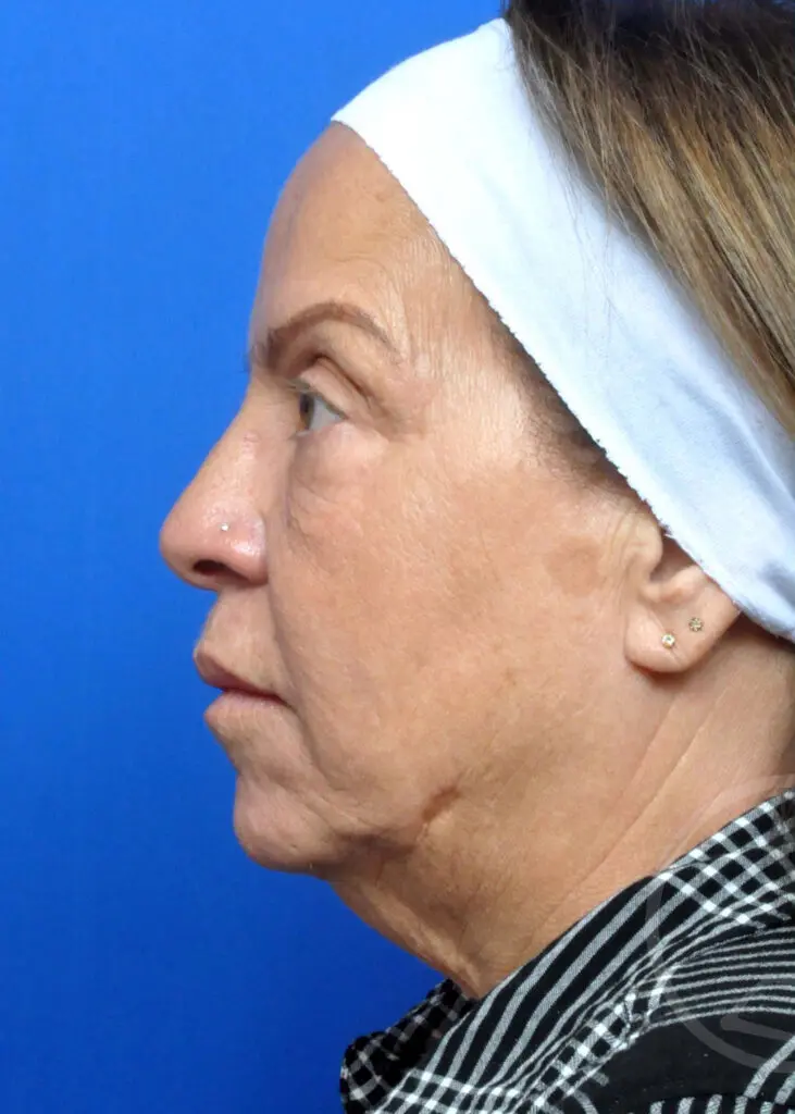 Plastic Surgery Before and After Pictures in Jacksonville, FL - Garcia Facial Plastic Surgery