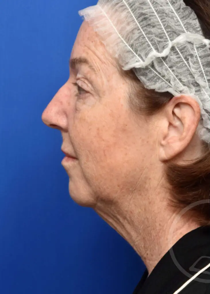 Plastic Surgery Before and After Pictures in Jacksonville, FL - Garcia Facial Plastic Surgery