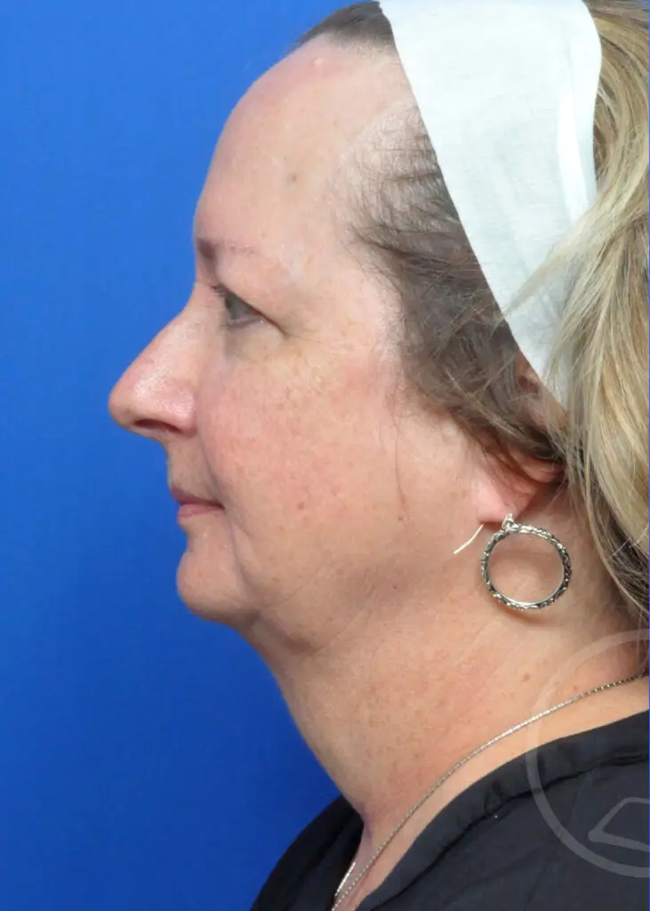 Plastic Surgery Before and After Pictures in Jacksonville, FL - Garcia Facial Plastic Surgery