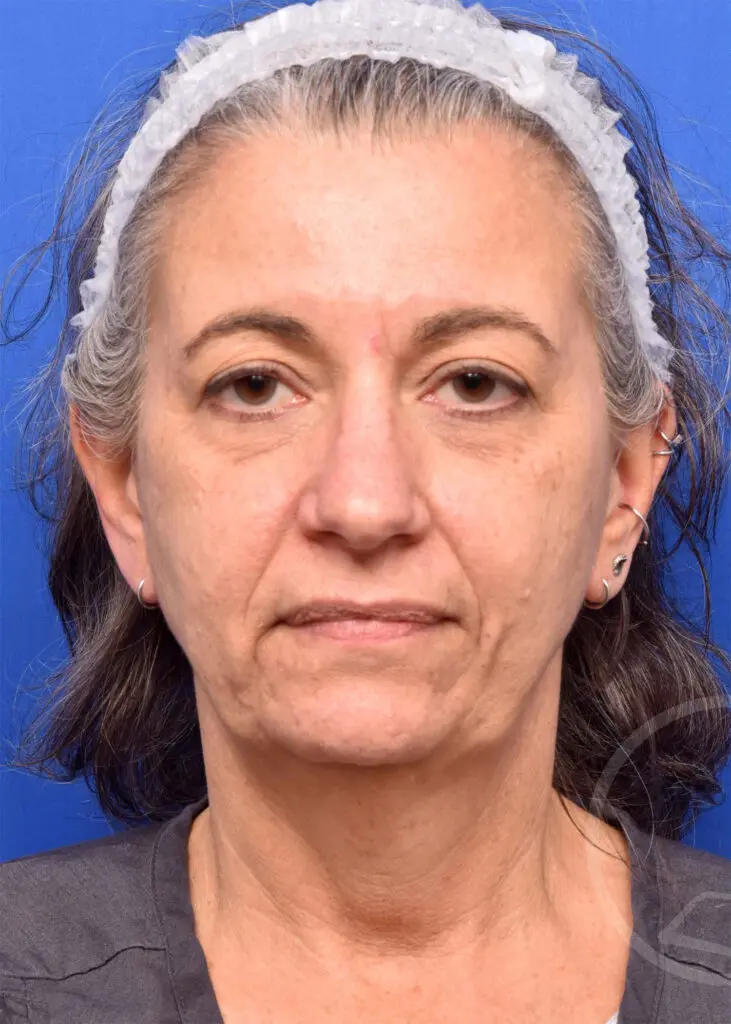 Plastic Surgery Before and After Pictures in Jacksonville, FL - Garcia Facial Plastic Surgery