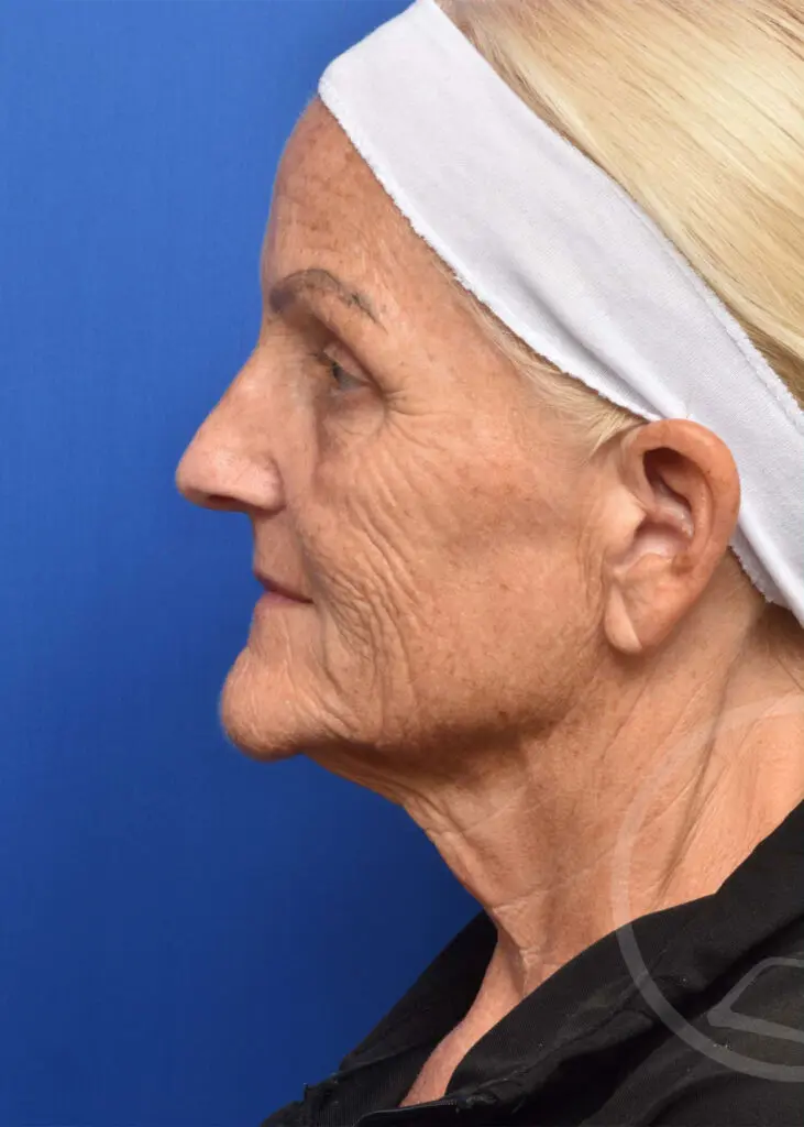 Plastic Surgery Before and After Pictures in Jacksonville, FL - Garcia Facial Plastic Surgery