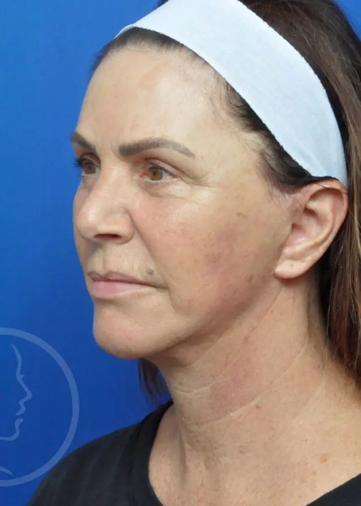 Plastic Surgery Before and After Pictures in Jacksonville, FL - Garcia Facial Plastic Surgery
