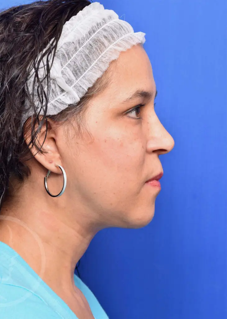 Plastic Surgery Before and After Pictures in Jacksonville, FL - Garcia Facial Plastic Surgery