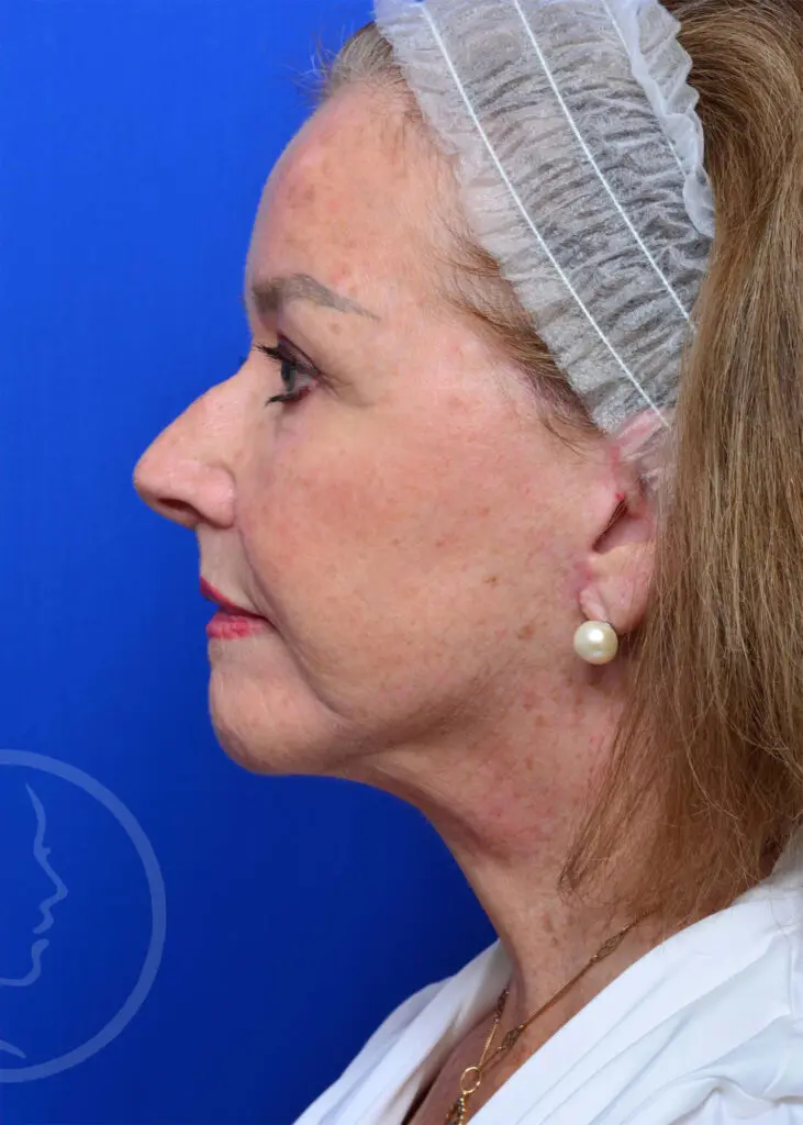 Plastic Surgery Before and After Pictures in Jacksonville, FL - Garcia Facial Plastic Surgery
