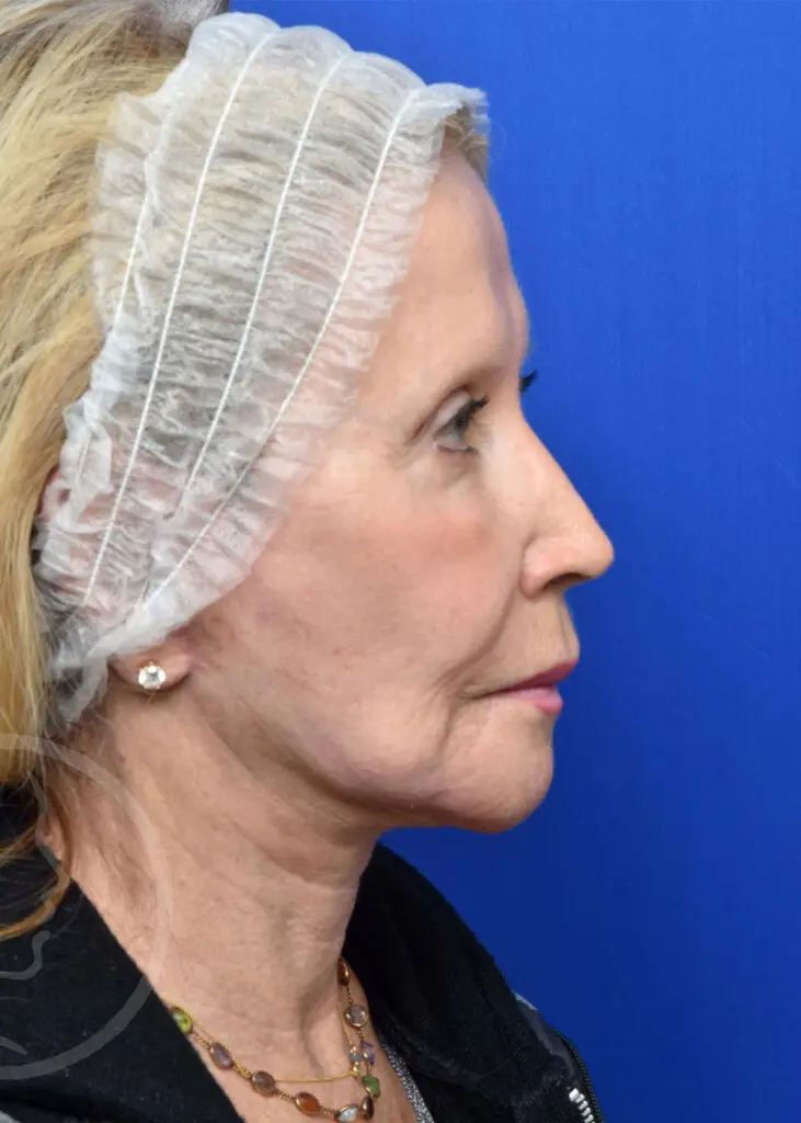 Plastic Surgery Before and After Pictures in Jacksonville, FL - Garcia Facial Plastic Surgery