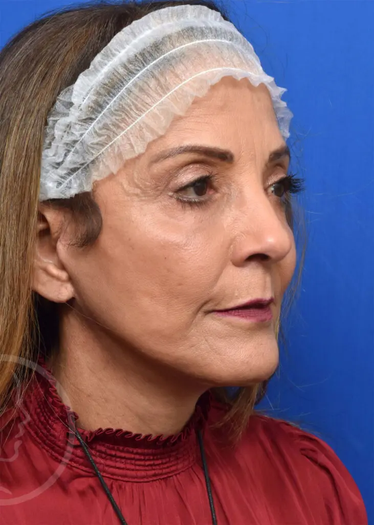 Plastic Surgery Before and After Pictures in Jacksonville, FL - Garcia Facial Plastic Surgery
