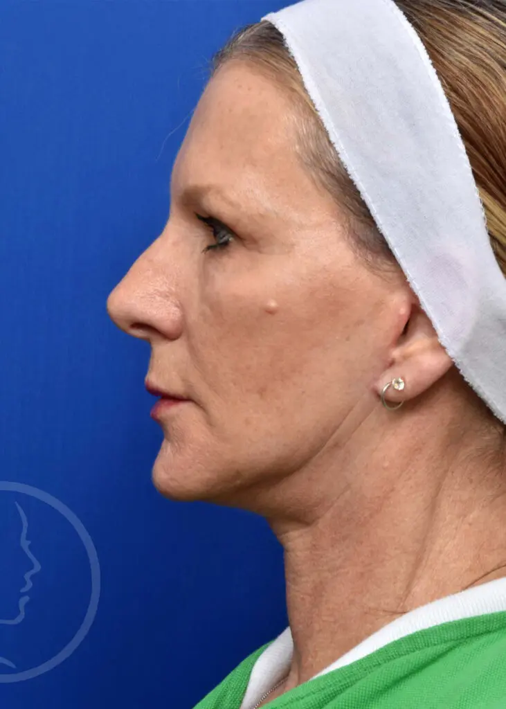 Plastic Surgery Before and After Pictures in Jacksonville, FL - Garcia Facial Plastic Surgery
