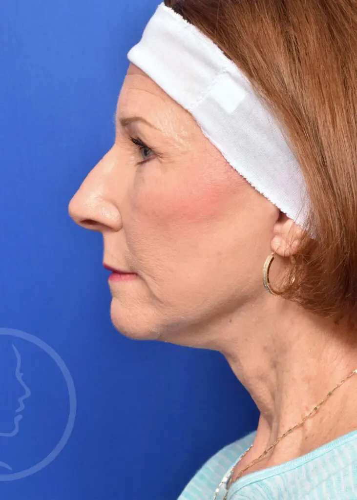 Plastic Surgery Before and After Pictures in Jacksonville, FL - Garcia Facial Plastic Surgery