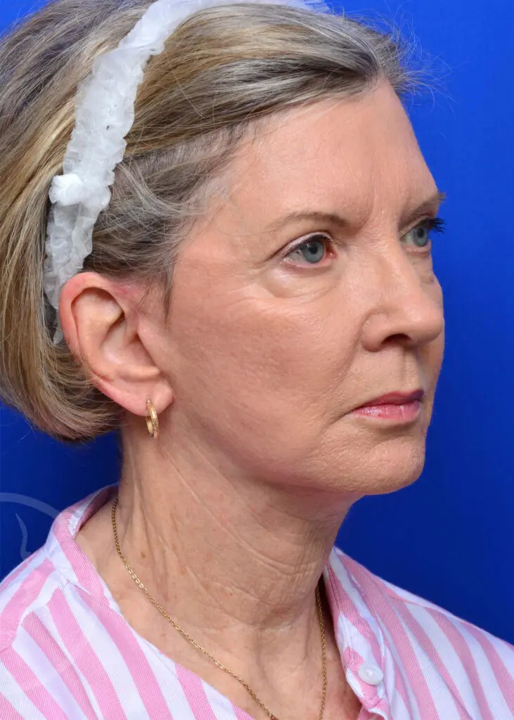 Plastic Surgery Before and After Pictures in Jacksonville, FL - Garcia Facial Plastic Surgery