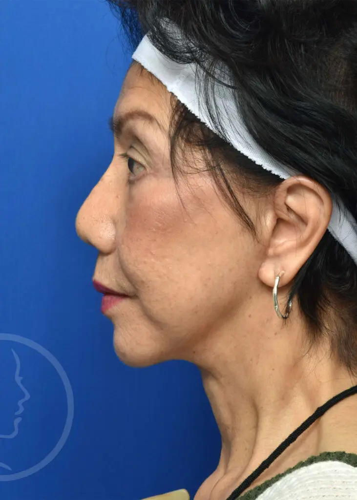 Plastic Surgery Before and After Pictures in Jacksonville, FL - Garcia Facial Plastic Surgery
